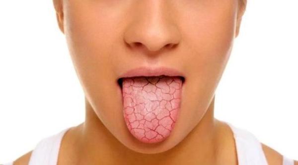 رایج ترین علل خشکی دهان